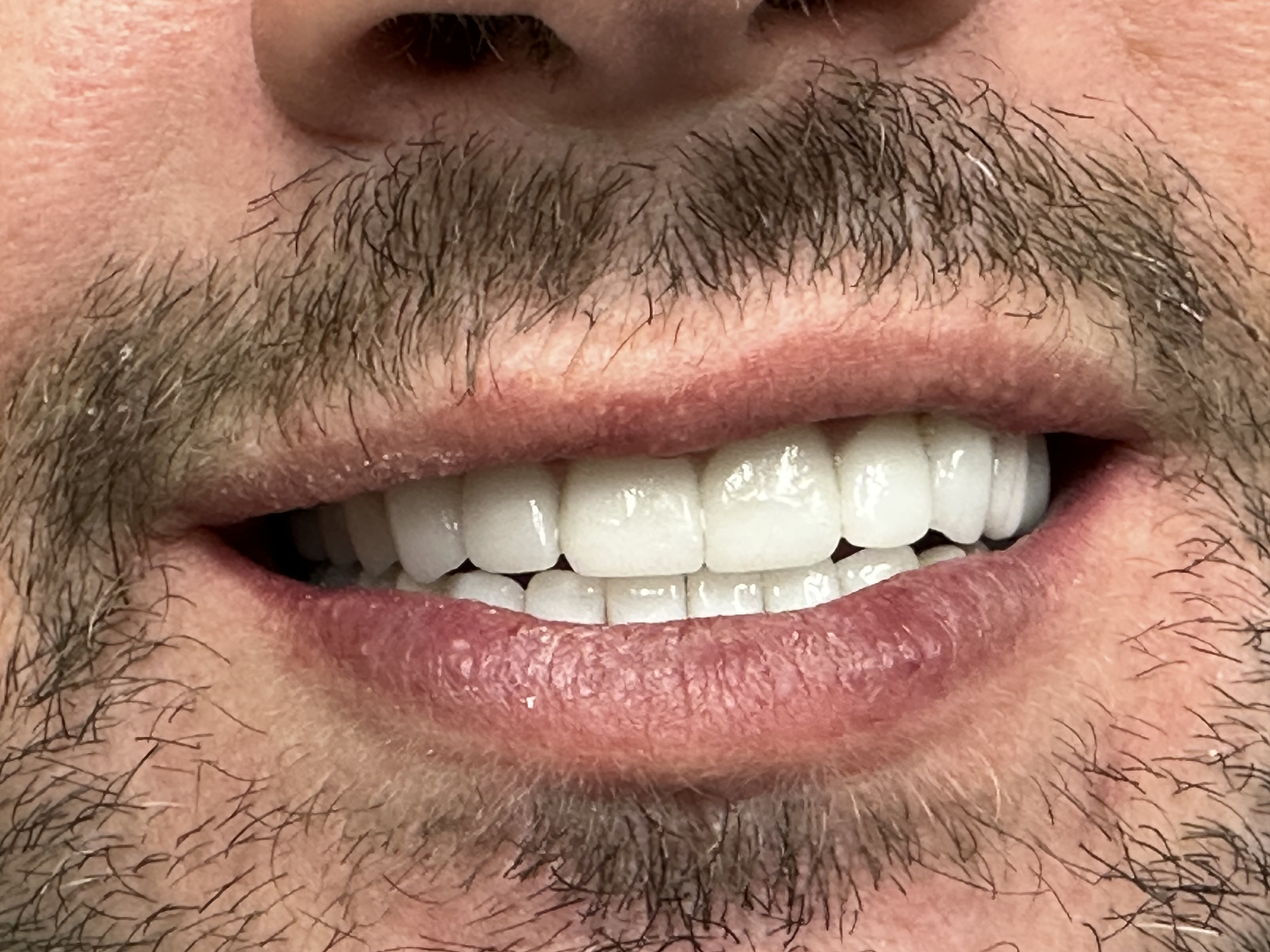 Final smile full mouth restoration